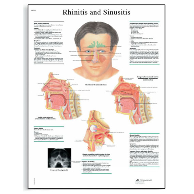 3B <b>독일</b> <b>비염</b>과 축농증차트 비코팅차트 4006669 Rhinitis and Sinusitis Chart <b>비염</b>차트 축농증차트 <b>비염</b>해부도 축농 VR1251UU
