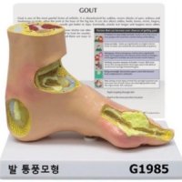 [GPI] 발 통풍 G1985 통풍모형