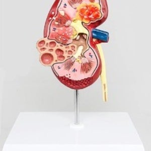 인체 신장질환 모형
