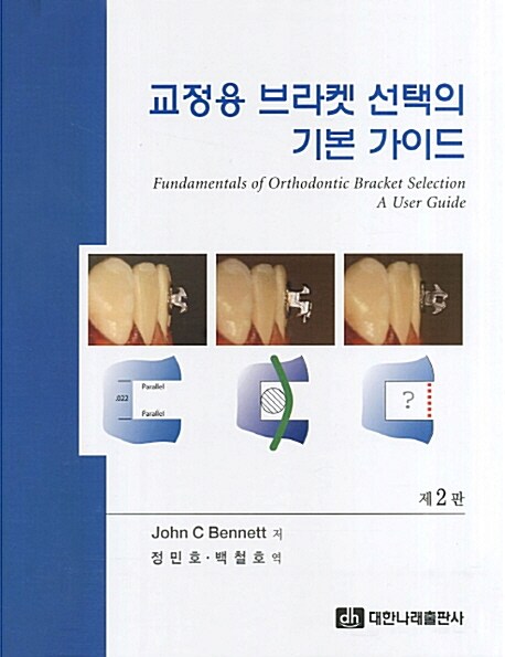 교정용 브라켓 선택의 기본 가이드