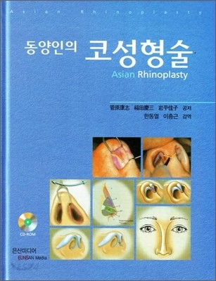 동양인의 코성형술 = Asian rhinoplasty