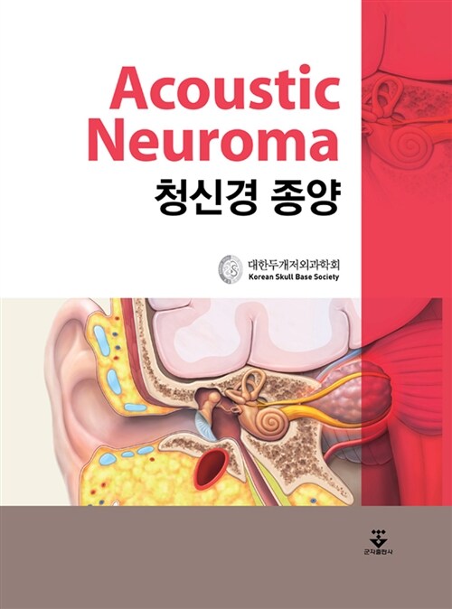 청신경 종양  = Acoustic Neuroma