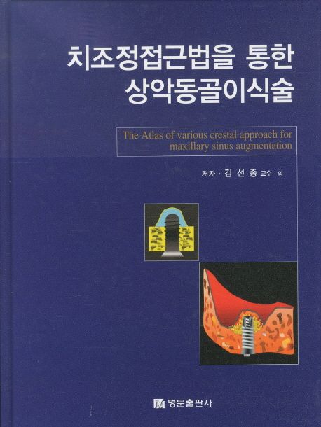 치조정접근법을 통한 상악동골이식술 = (The) atlas of various crestal approach for maxillary sinus augmentation