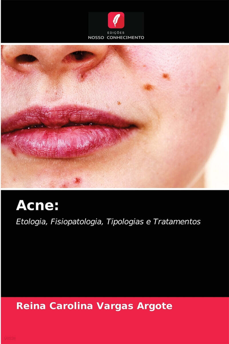 Acne