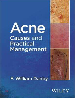 Acne (Causes and Practical Management)