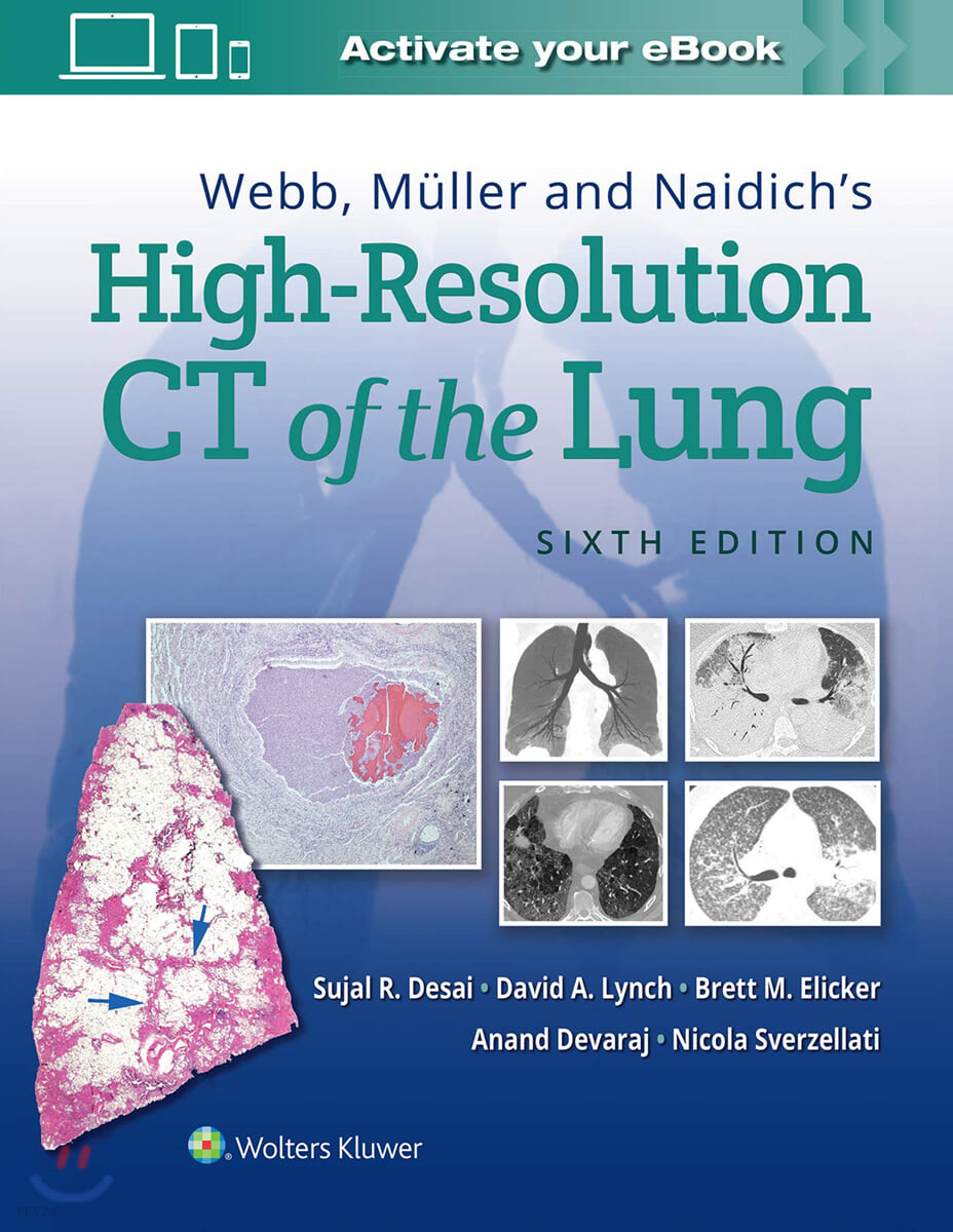 Webb, Muller and Naidich’s High-Resolution CT of the Lung