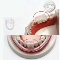마우스피스 무성형 치아보호 이갈이 수면교정 치아커버 이악물기방지