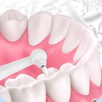 치아미백기계 미백제 미백칫솔 누렁니 이빨
