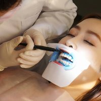 SMILEKIT 치아 미백겔 미백젤 화이트닝겔 잇몸 보호제 Gingiaval Barrier 3P 9P