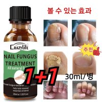 1+1 조갑사상균리페어 에센스 갑구염 복구 화농성 및 부종/ 폴립 통증/ 조내생  30ml*1+1