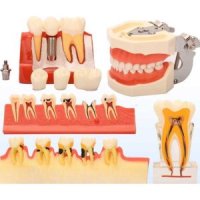 치아모형 치과 레진 틀니모델 치아구조 구강교육 모델