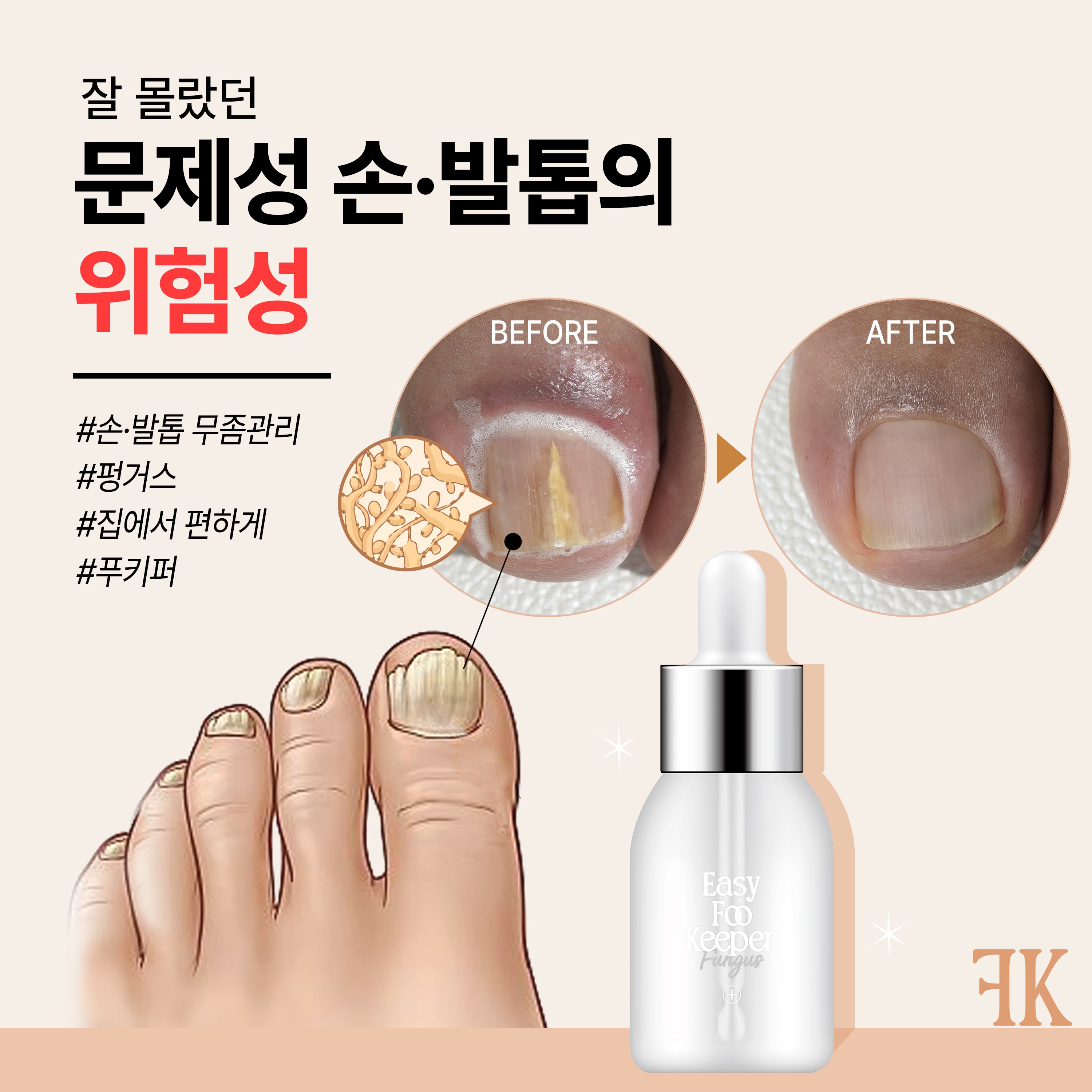 <b>이지</b> 푸키퍼 문제성 <b>손발톱</b> 개선제 무좀 내성발톱 갈라짐 케어  1개  30ml