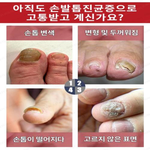 <b>손톱</b> 즉시 확보