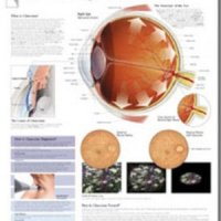 평면해부도(벽걸이)/ 2250 /녹내장/Understanding Glaucoma / 사이즈   56cm ⅹ 71cm Paper