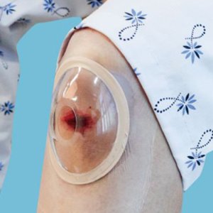 안다찌 상처보호캡 대형 중형 소형 - 복강경수술 대상포진 화상 방수 드레싱밴드