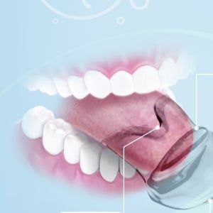 혀골무 혀교정기 혀고정기 리테이너 교정