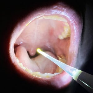 편도 결석 제거기 셀프 편도석 빼는법 구강 입똥 목똥 제거 이물질 흡입기