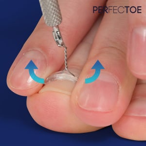 [퍼펙토 내성발톱 교정 픽스 V3 SET] 내성 발톱 교정기 의료기기 와이어 후크 세트